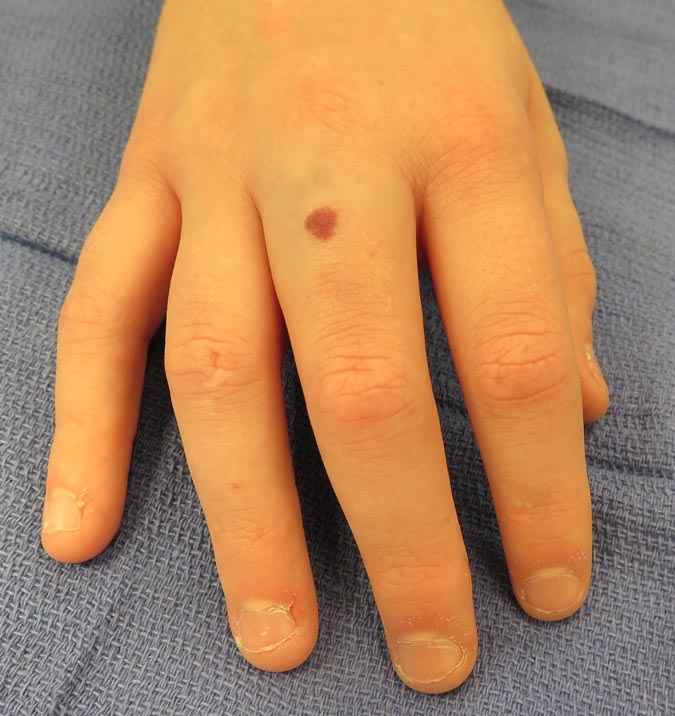 hemangioma-hand-surgery-source